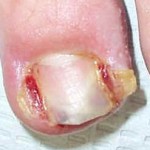 Ingrown nails